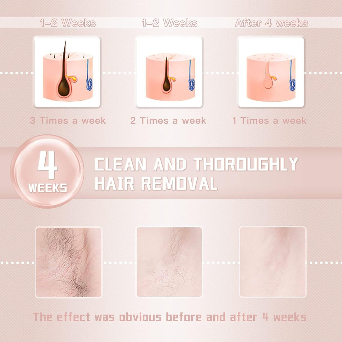 IPL Laser Hair Removal Device for Women